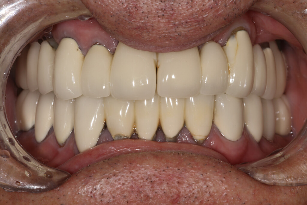 Full Upper With Pink Porcelain Gingival FTI Dental Lab