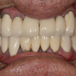 Full Upper With Pink Porcelain Gingival FTI Dental Lab