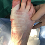 Hallux Valgus Correction Bunion Surgery Gallery Kinvara Private