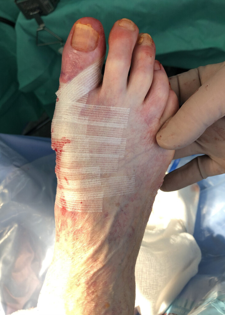 Hallux Valgus Correction Bunion Surgery Gallery Kinvara Private 