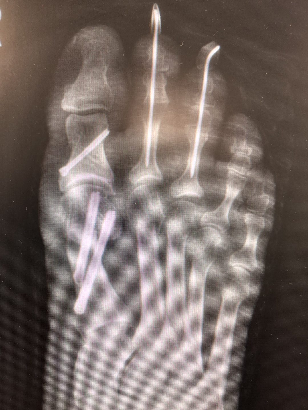 Hallux Valgus Correction Bunion Surgery Gallery Kinvara Private