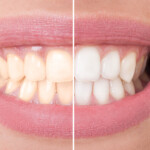 Teeth Whitening Ozark MO Opalescence Go Zoom Laser Whitening