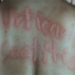 Urtikaria Network E V Urticaria Factitia