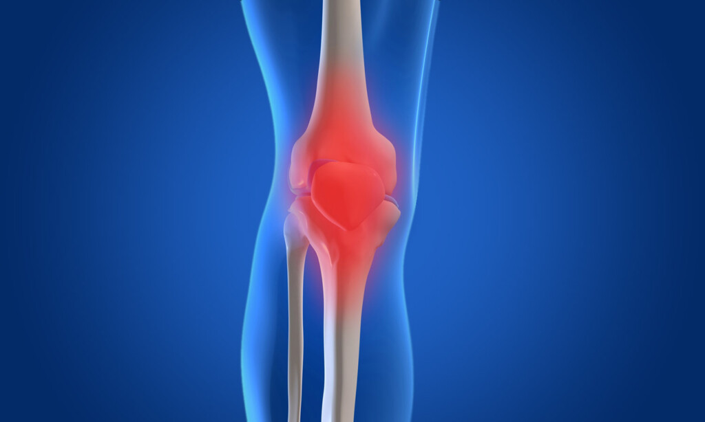 What Is Osteoarthritis 